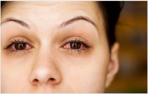 آشوبِ چشم : علامات، احتیاط اور علاج